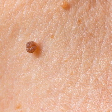 Warts Removal